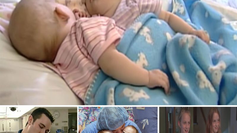 10 years ago these conjoined twins were separated through advanced surgery: Now they are all grown up