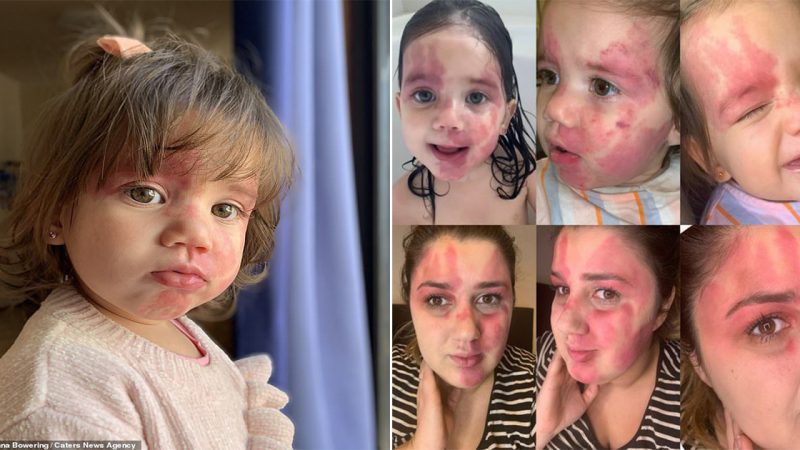 The emotional journey of a resilient baby with a lovely nose and a charming birthmark