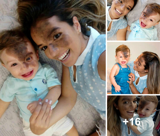 Mother Paints Black Birthmark on Her Face to Boost Her Child’s Self-Esteem