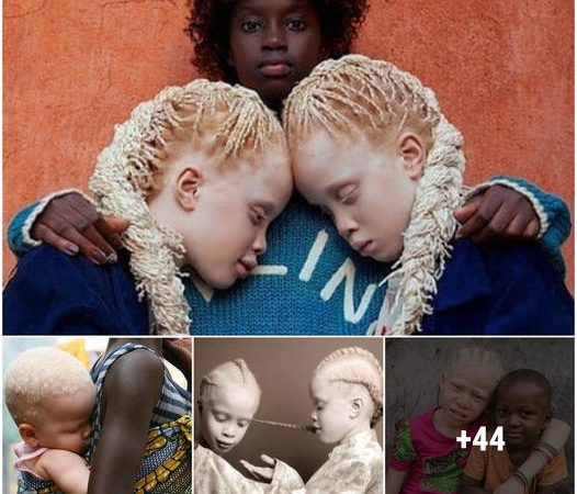 Rare Occurrence: Mother Welcomes Albino Twins into the World