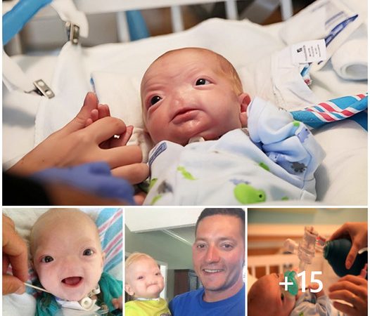 The Imperfect Beauty of a Noseless Baby Touches Hearts