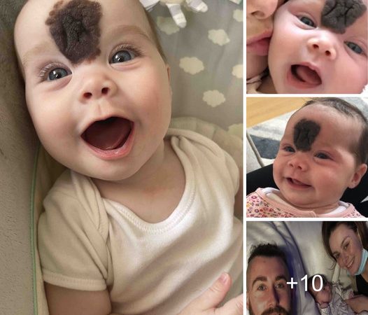 Surprising Arrival: Medical Team’s Reaction to a Baby Born with a Prominent Forehead Mole