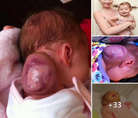 A Mother’s Fear: When a Birthmark Looked Like Something More