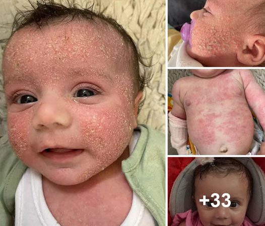 Miraculous Transformation: £7.99 Cream Rescues Baby from Agonizing Eczema