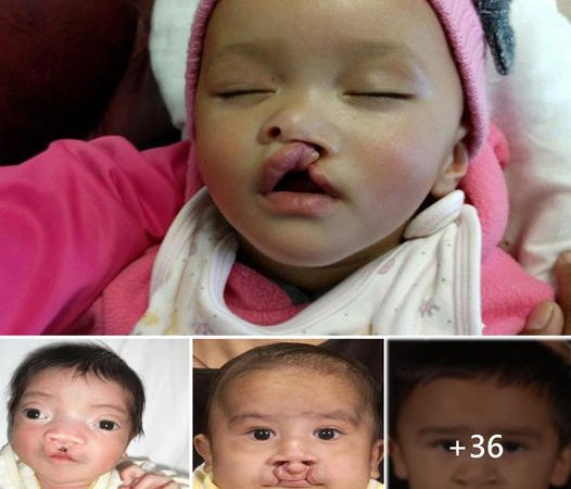 Unveiling Strength: A Newborn’s 9-Week Journey with Cleft Lip and Palate